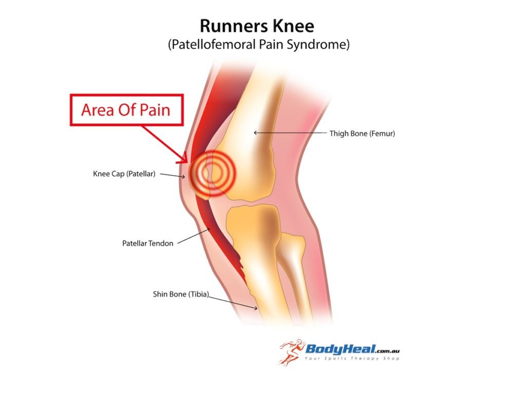 runners-knee-image-3